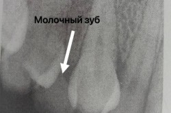 24-летней каширянке удалили молочные зубы, с которыми она проходила с детства
