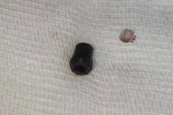 Каширские врачи извлекли из уха пациента застрявший беспроводной наушник