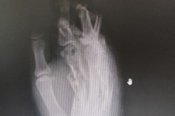 В Кашире врачи спасли пациентке руку, попавшую в электромясорубку