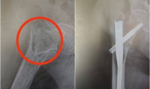 Каширские врачи поставили на ноги 101-летнюю женщину c переломом бедра