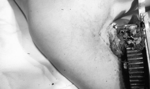 Врачи в Кашире спасли девушке руку, попавшую в зернодробильную машину