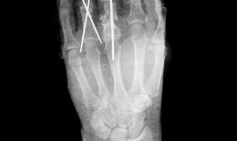 В Кашире мужчина отрезал пальцы болгаркой и принес их в больницу помещенными в банке