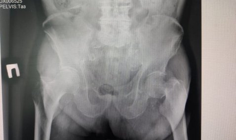 В Кашире травматологи поставили на ноги 92-летнего пациента