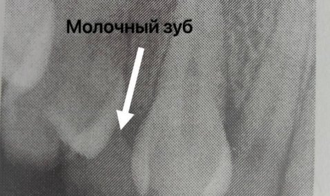 24-летней каширянке удалили молочные зубы, с которыми она проходила с детства