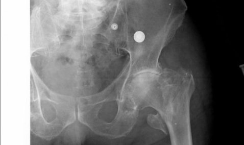 Каширские врачи пришли на помощь ветерану Великой Отечественной, получившему тяжелый перелом