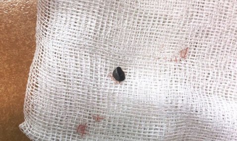 Каширянину при покосе травы разрезало живот отскочившим обломком триммера