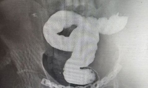 Каширские врачи спасли жизнь мужчине, которого на стройке придавила железобетонная плита
