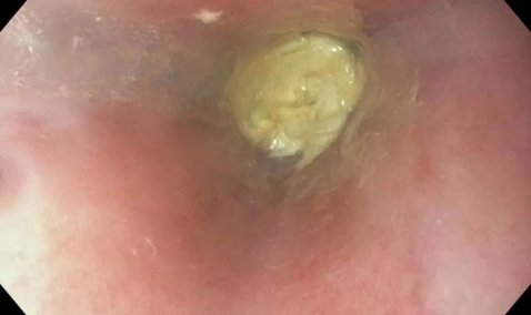 Застрявший в пищеводе кусок курицы едва не стоил жизни каширянину