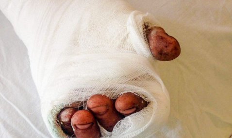 Каширские врачи пришили мужчине отрезанный «болгаркой» палец