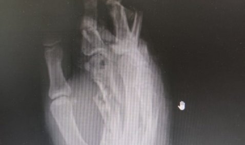 В Кашире врачи спасли пациентке руку, попавшую в электромясорубку