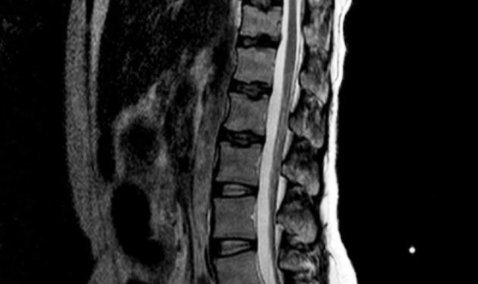 Каширские врачи вернули способность ходить пациентке с тяжелой болезнью позвоночника